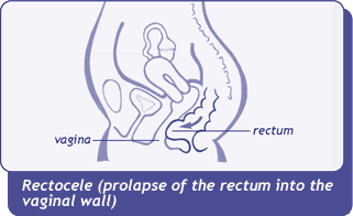 diagram of rectocele