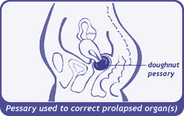 diagram of pessary in place